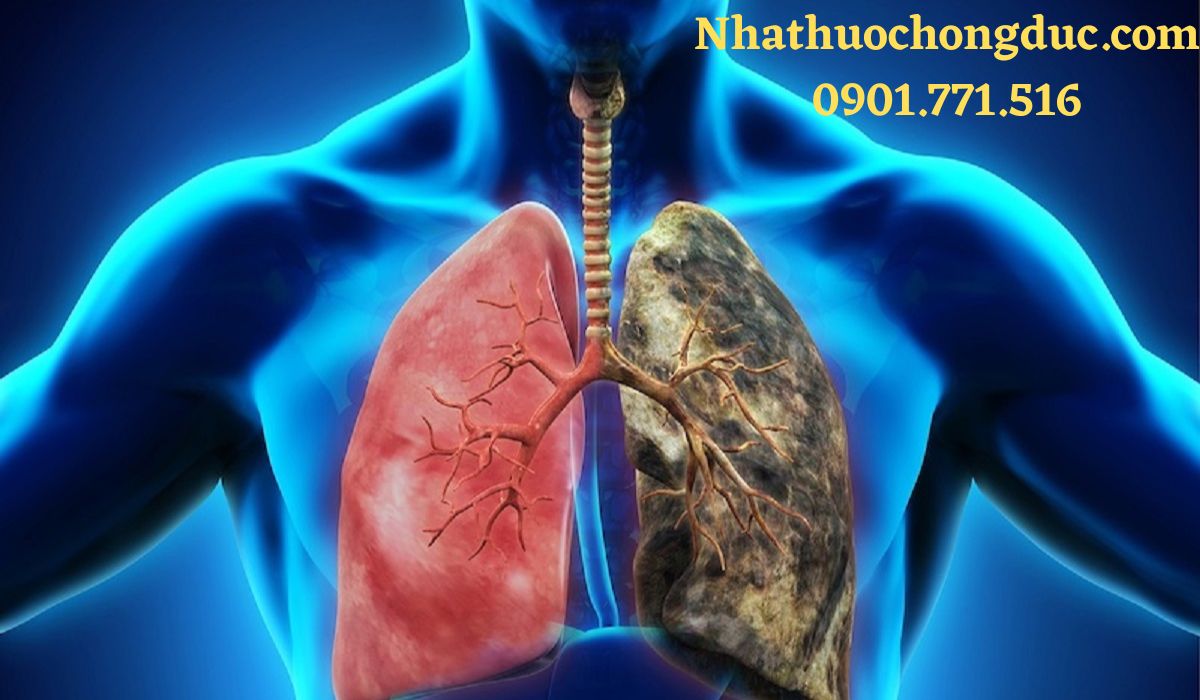 Ung thư phổi: Tổng quan về dấu hiệu, chẩn đoán và cách điều trị
