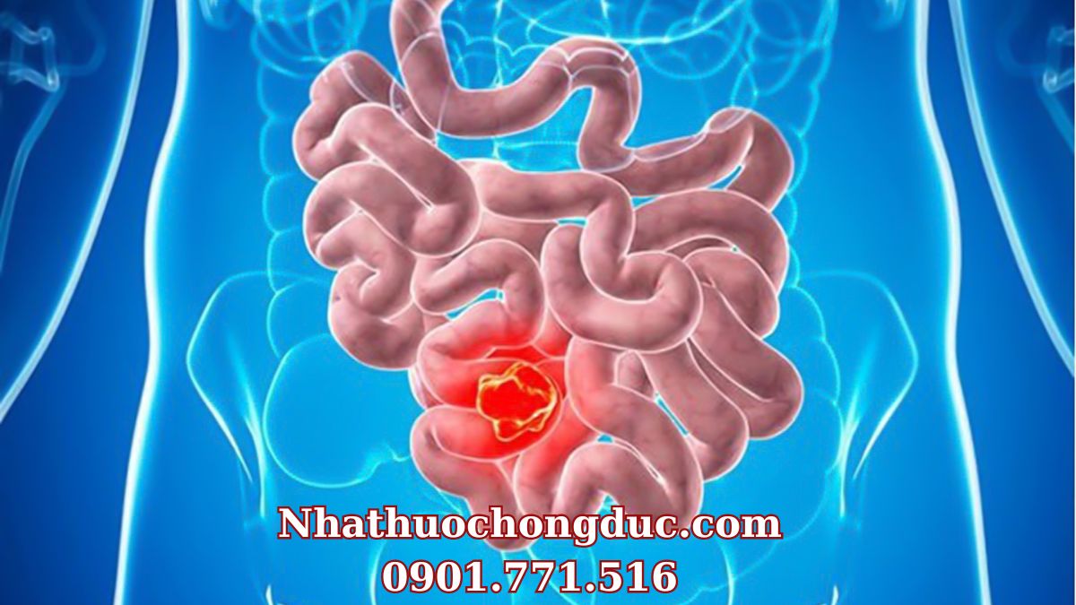 Ung thư ruột non - Dấu hiệu, chẩn đoán cùng cách điều trị